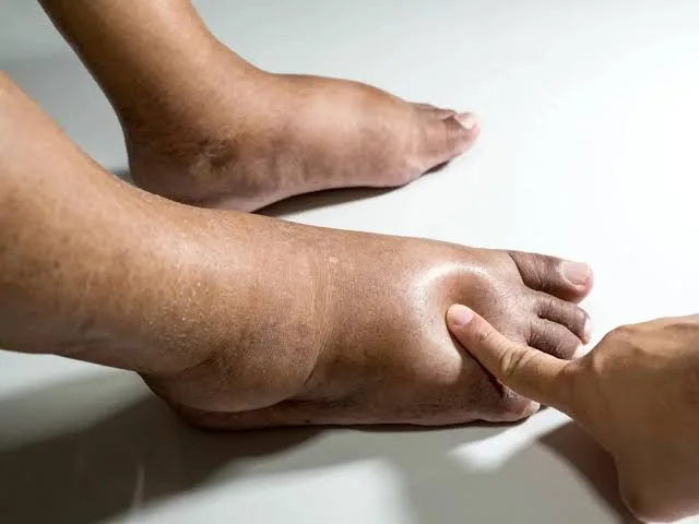 Bengkak kaki
